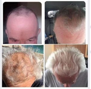 LifeWave X39 Hair Growth