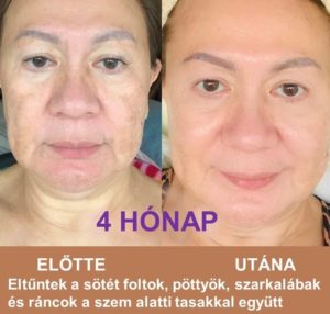 lifewave x39 face before and after